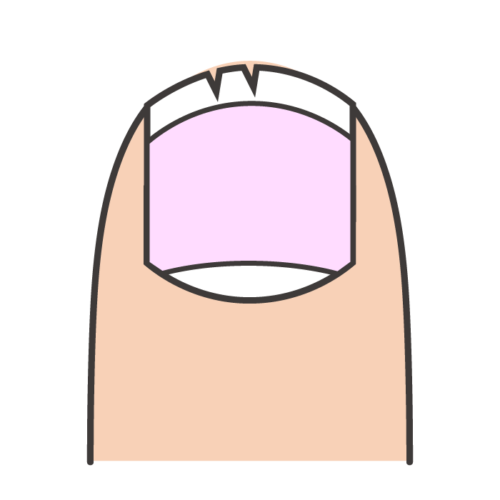 爪が縦に割れている状態のイラスト
